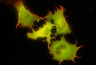 Molecular regulation of the cytoskeleton and melanoma progression