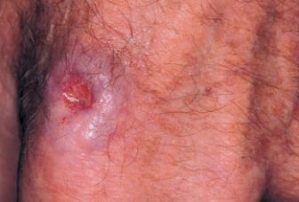 Radon and Skin Cancer in Southwest England: An Ecologic Study